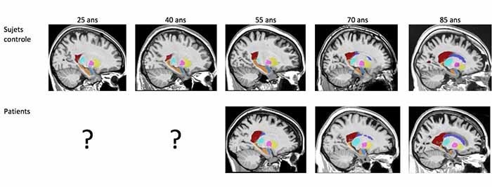 Rouge = ventricules latéraux, Orange = hippocampe et bleu = amygdale. Atrophie de l’hippocampe et de l’amygdale plus précoces et plus prononcées et élargissement précoce des ventricules latéraux pour les patients atteints d’Alzheimer. © Pierrick Coupé, LABRI (CNRS/Bordeaux INP/Université de Bordeaux).