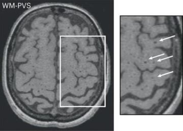 IRM cérébrale montrant une charge importante en espace périvasculaire dans la substance blanche © Nature Medicine